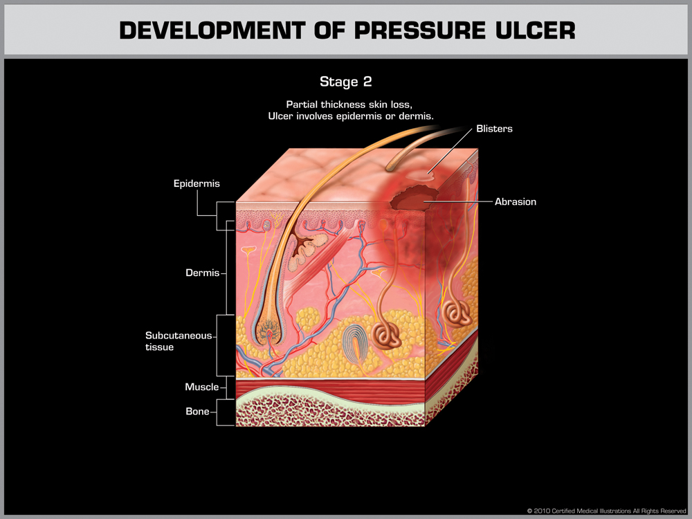Stage 2 - Partial Thicknewss skin loss, Ulcer involves epidermis or dermis.