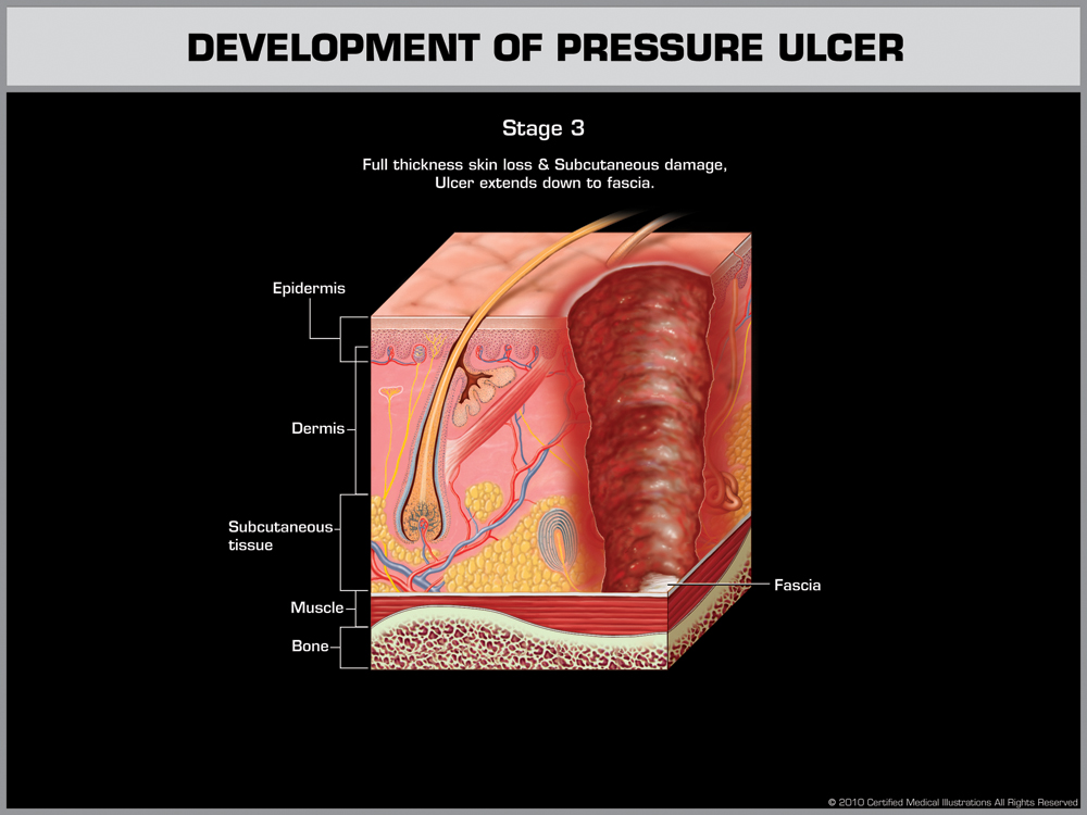 Stage 3 - Full thickness skin loss and Subcutaneous damage, Ulcer extends down to fascia