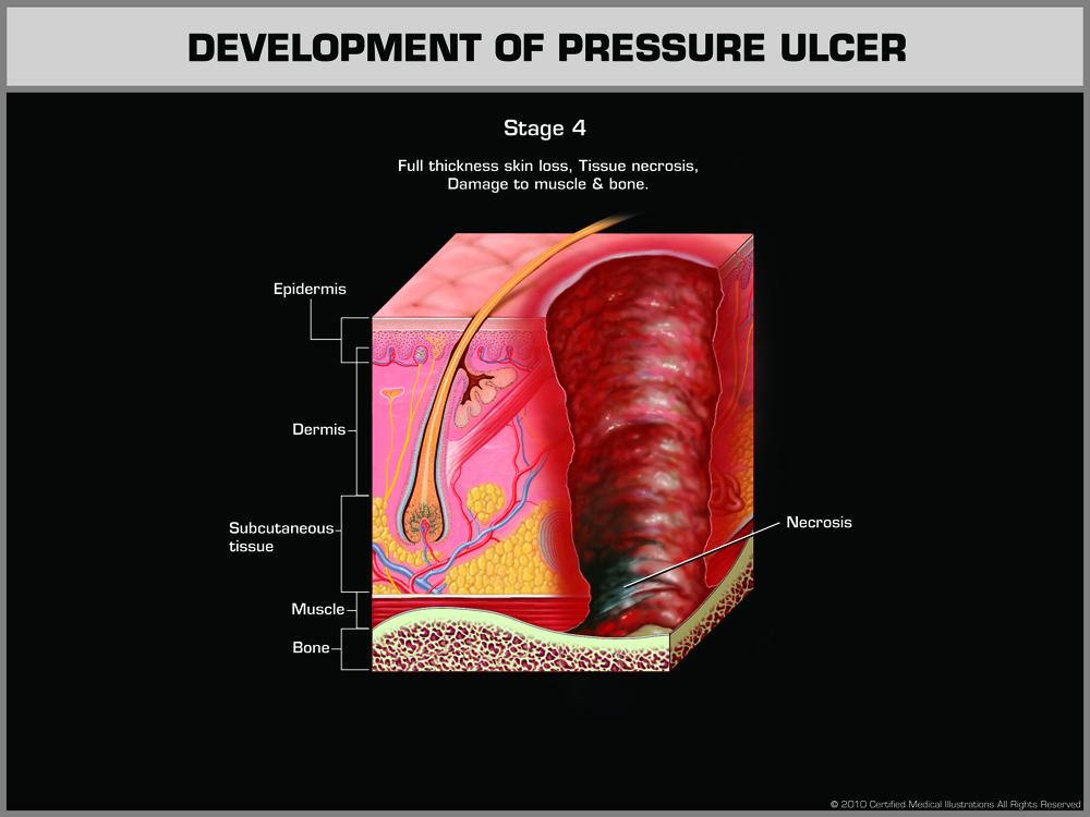 Stage 4 - Full thickness skin loss, Tissue necrosis, Damage to muscle and bone.